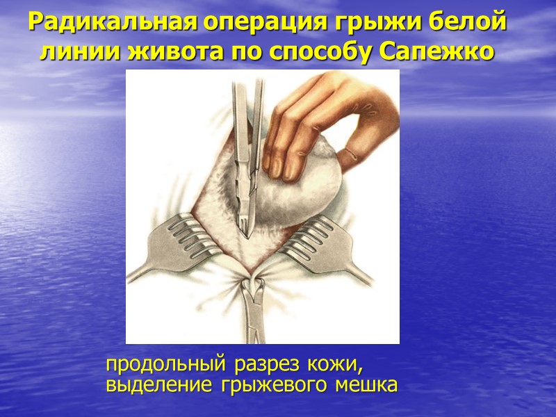 Радикальная операция грыжи белой линии живота по способу Сапежко продольный разрез кожи, выделение грыжевого